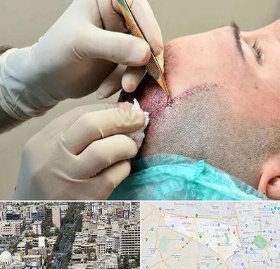 اسکالپ موی سر در منطقه 18 تهران 