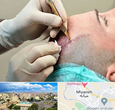 اسکالپ موی سر در میانه