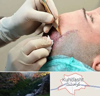 اسکالپ موی سر در کوهدشت