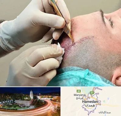 اسکالپ موی سر در همدان