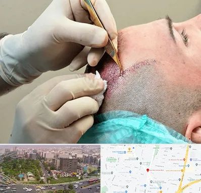 اسکالپ موی سر در آیت الله کاشانی 