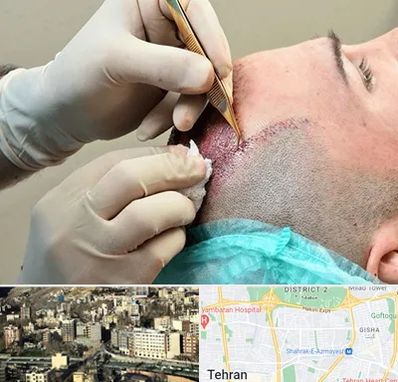 اسکالپ موی سر در مرزداران 