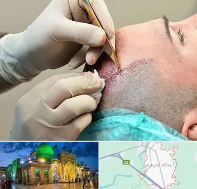 اسکالپ موی سر در آستانه اشرفیه