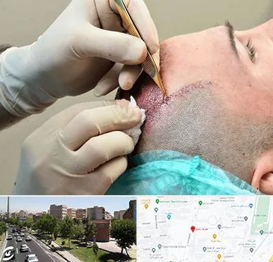 اسکالپ موی سر در شهرک آزمایش 