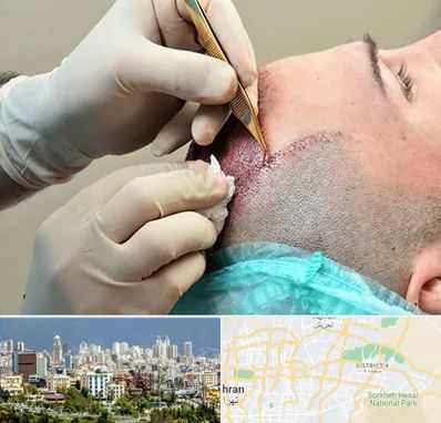 اسکالپ موی سر در شرق تهران 