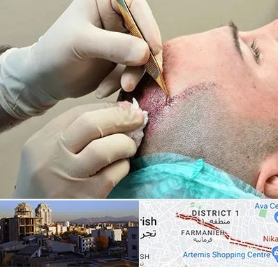 اسکالپ موی سر در فرمانیه 