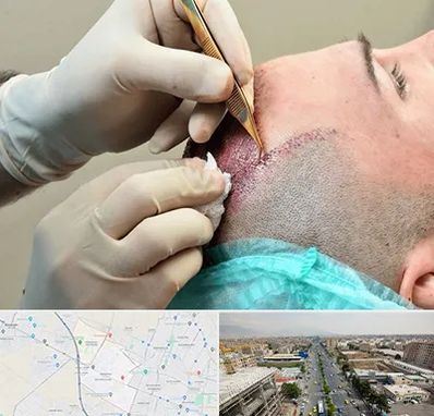 اسکالپ موی سر در حصارک کرج 