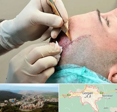 اسکالپ موی سر در گرگان