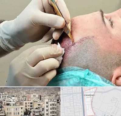 اسکالپ موی سر در اسکندری