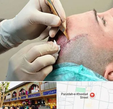 اسکالپ موی سر در 15 خرداد