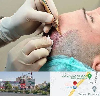 اسکالپ موی سر در هروی 