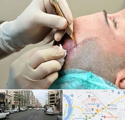 اسکالپ موی سر در زیتون کارمندی اهواز 