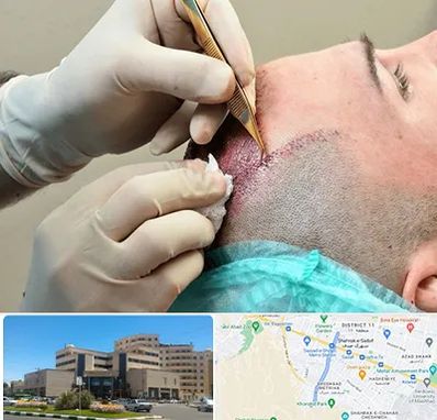 اسکالپ موی سر در صیاد شیرازی مشهد 