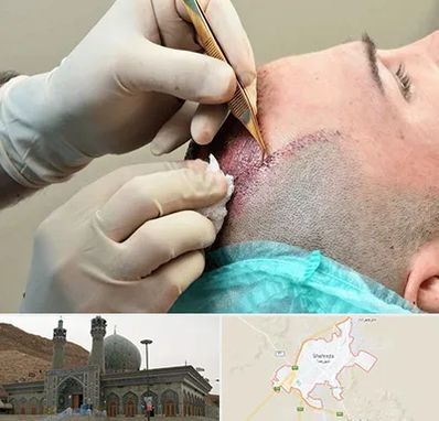 اسکالپ موی سر در شهرضا