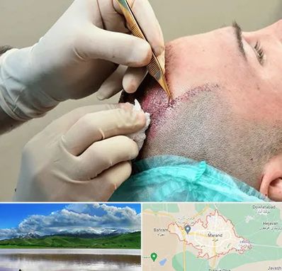 اسکالپ موی سر در مرند