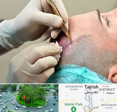 اسکالپ موی سر در تجریش 