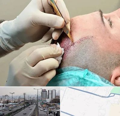 اسکالپ موی سر در بلوار ارتش