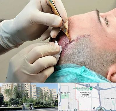 اسکالپ موی سر در آپادانا