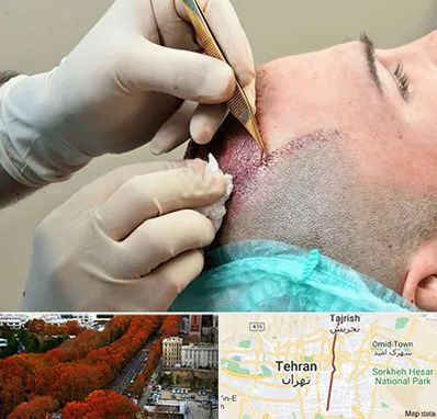 اسکالپ موی سر در ولیعصر 