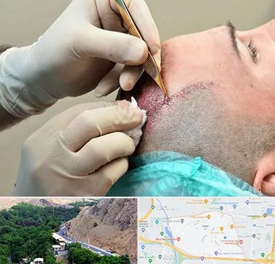 اسکالپ موی سر در کن 