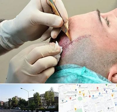 اسکالپ موی سر در میدان کاج 