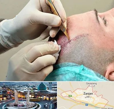اسکالپ موی سر در زنجان