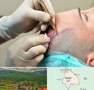 اسکالپ موی سر در آمل