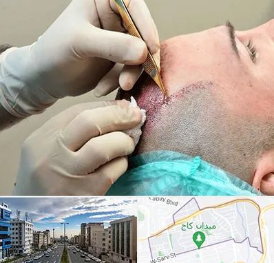 اسکالپ موی سر در سعادت آباد 