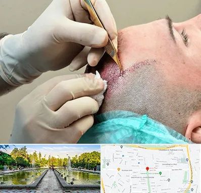 اسکالپ موی سر در سرسبز 