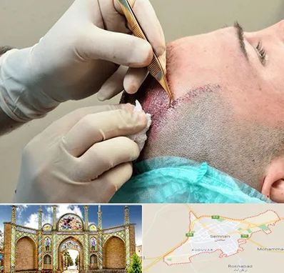 اسکالپ موی سر در سمنان