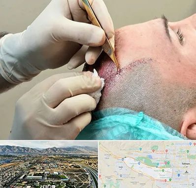 اسکالپ موی سر در منطقه 21 تهران 