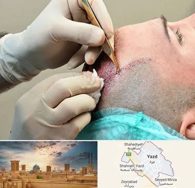 اسکالپ موی سر در یزد