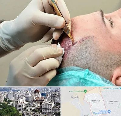 اسکالپ موی سر در ولنجک 