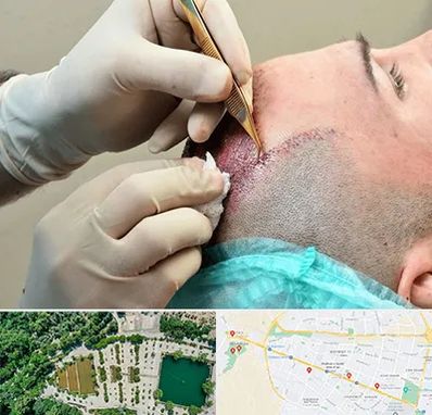 اسکالپ موی سر در وکیل آباد مشهد 