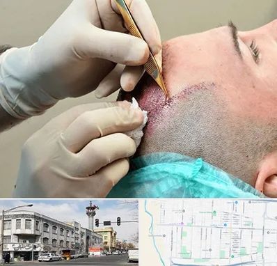 اسکالپ موی سر در 17شهریور