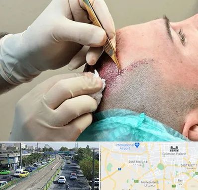 اسکالپ موی سر در جنوب تهران 