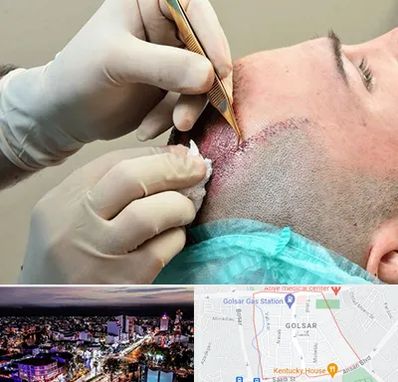 اسکالپ موی سر در گلسار رشت 