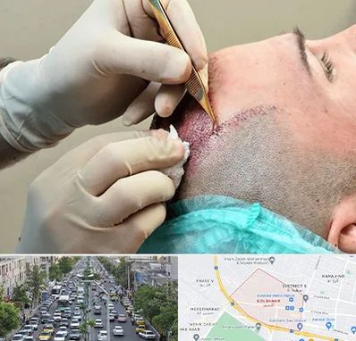 اسکالپ موی سر در گلشهر کرج 