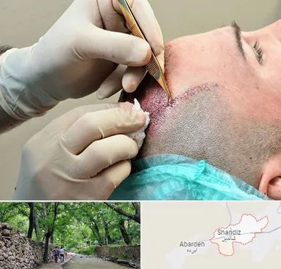 اسکالپ موی سر در شاندیز مشهد