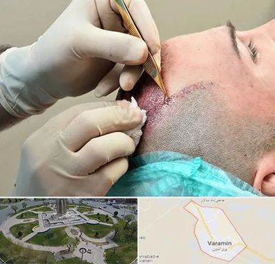 اسکالپ موی سر در ورامین