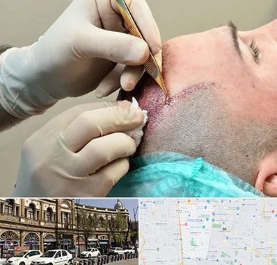 اسکالپ موی سر در منطقه 11 تهران 