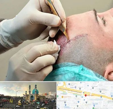 اسکالپ موی سر در رسالت 