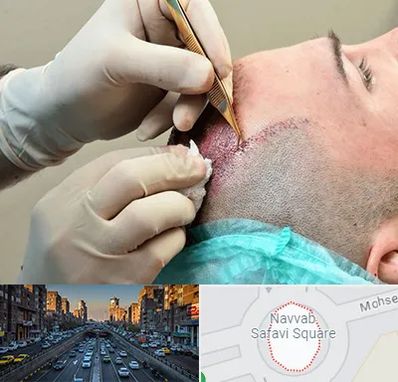 اسکالپ موی سر در نواب 