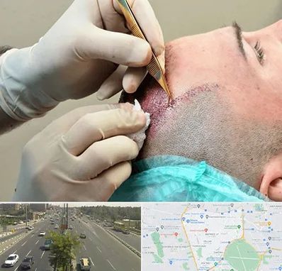 اسکالپ موی سر در منطقه 17 تهران 