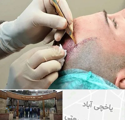 اسکالپ موی سر در یاخچی آباد