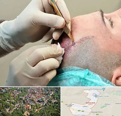 اسکالپ موی سر در دماوند