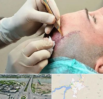 اسکالپ موی سر در میاندوآب