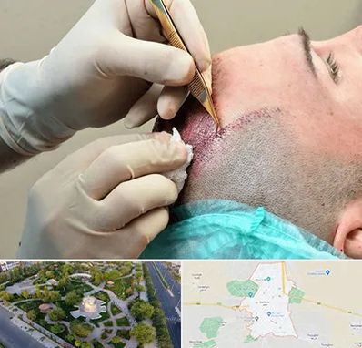 اسکالپ موی سر در کاشمر