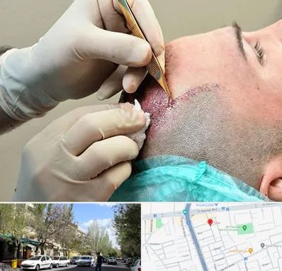 اسکالپ موی سر در کوی فیروز تبریز