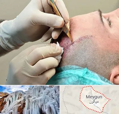 اسکالپ موی سر در میگون